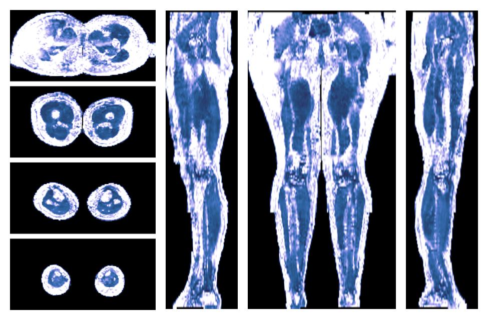 IVIM corrected whole leg muscle fractional anisotropy obtained from diffusion tensor imaging.