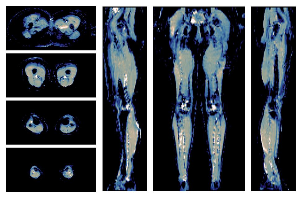 IVIM corrected whole leg muscle mean diffusivity obtained from diffusion tensor imaging.