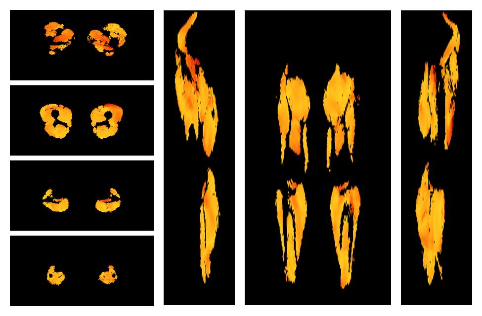 Muscle fiber tract angle map based on whole leg DTI based fiber tractography.