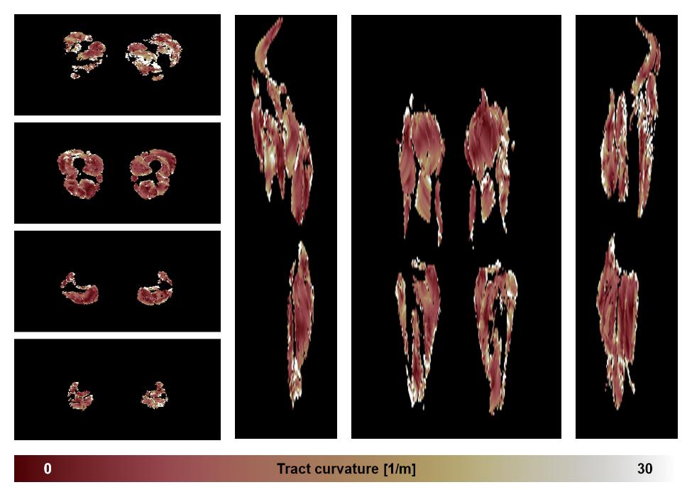 Muscle fiber tract curvature map based on whole leg DTI based fiber tractography.