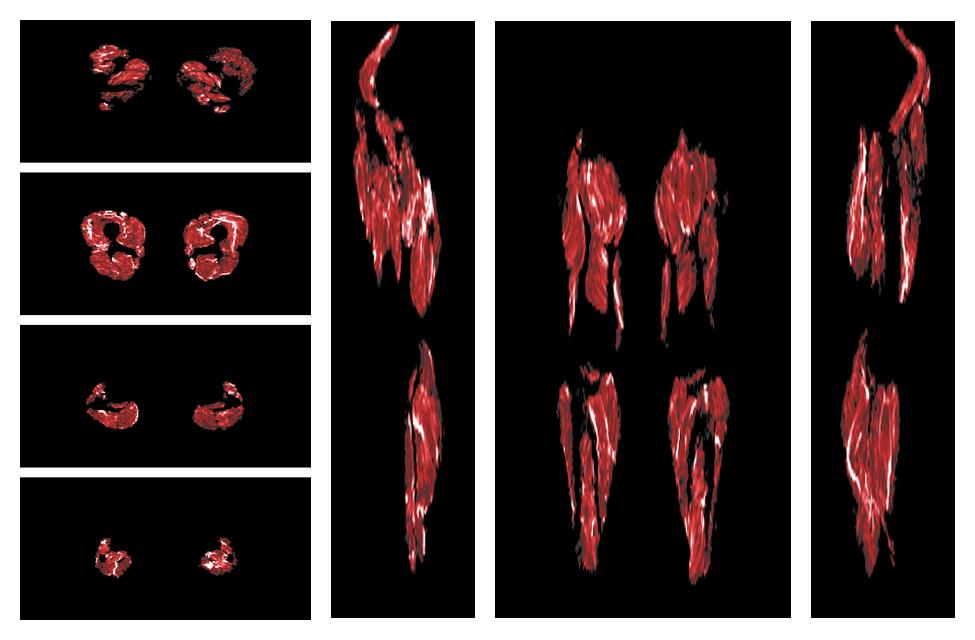 Muscle fiber tract density map based on whole leg DTI based fiber tractography.