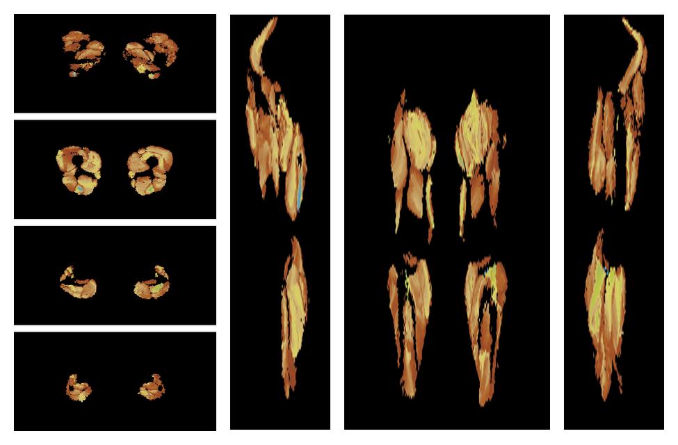 Muscle fiber tract length map based on whole leg DTI based fiber tractography.