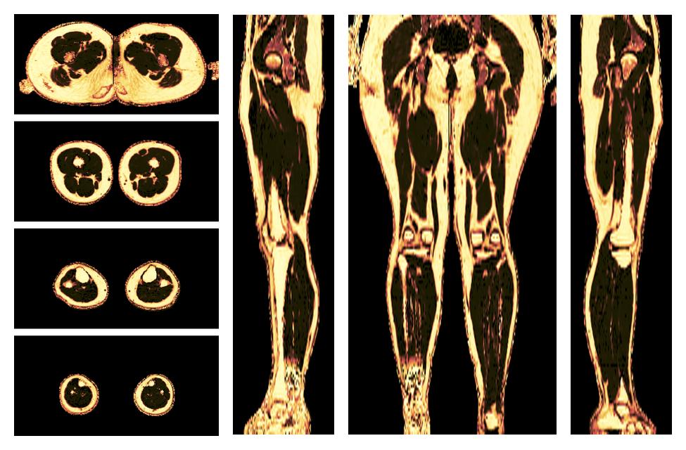 The fat fraction of the lower extremity obtained from the dixon reconstruction for muscle water fat quantification.