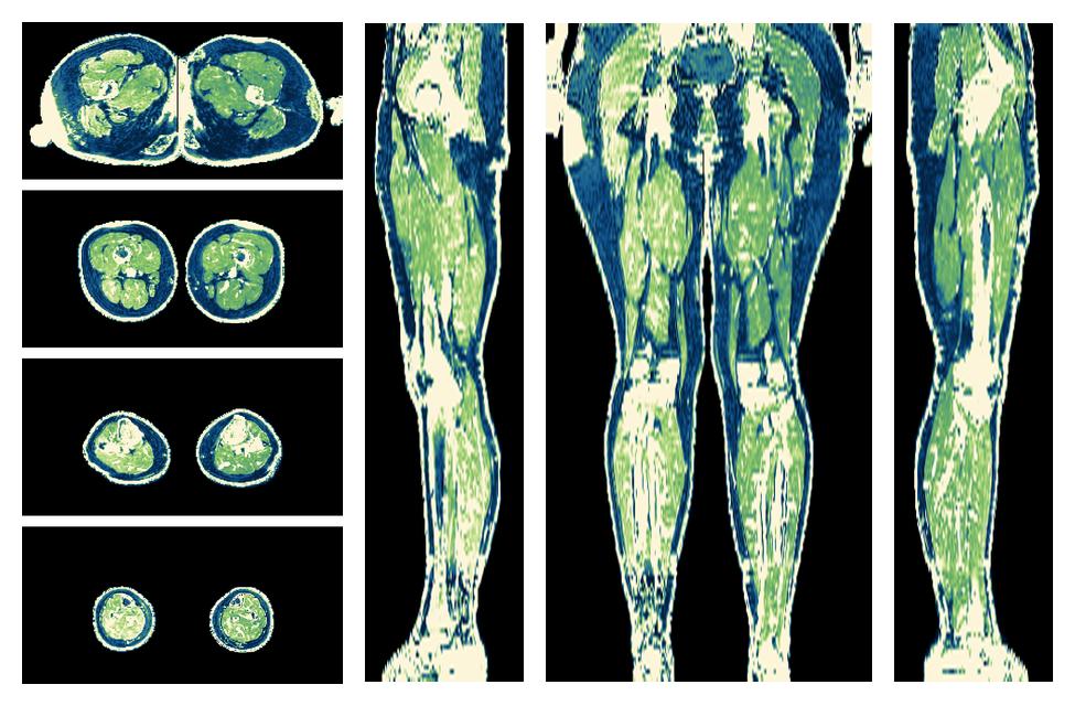 The R2 star relaxation time of the lower extremity obtained from the dixon reconstruction for muscle water fat quantification.