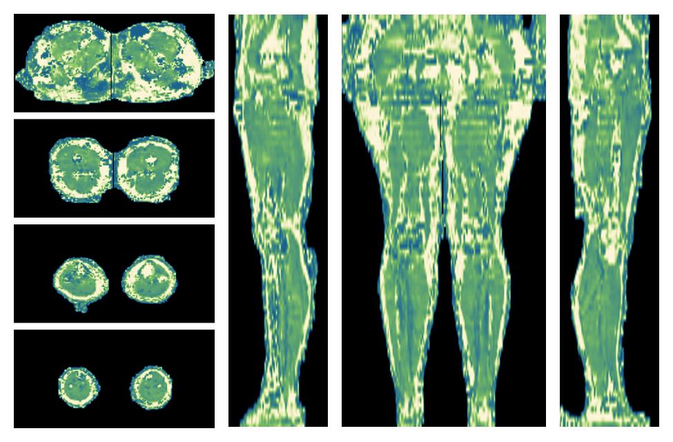 The water only T2 relaxation time of the lower extremity obtained from multi echo spin echo t2 mapping with EPG based reconstruction.