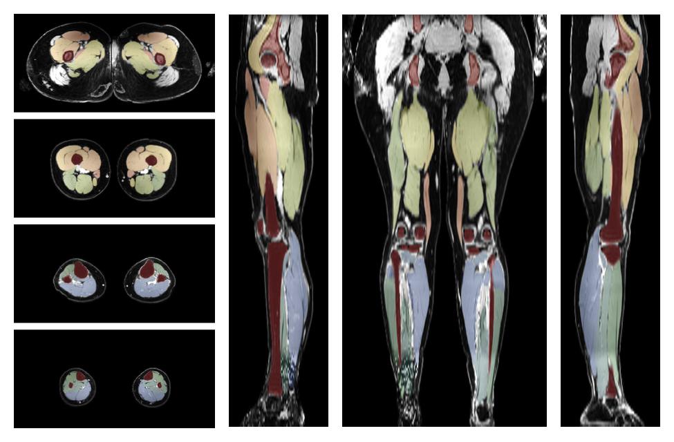 Overlay of automated muscle segmentation labels on dixon water image.