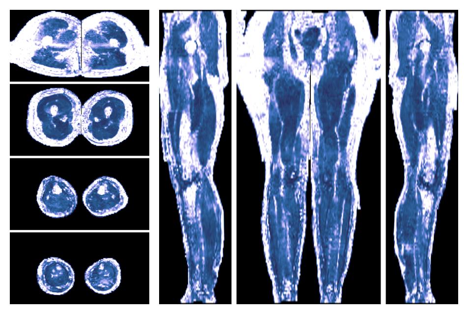 IVIM corrected whole leg muscle fractional anisotropy obtained from diffusion tensor imaging.