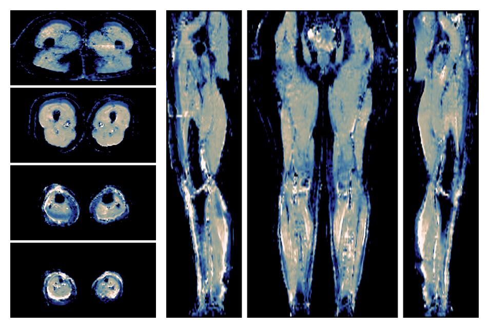 IVIM corrected whole leg muscle mean diffusivity obtained from diffusion tensor imaging.