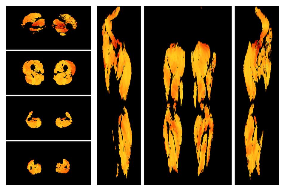 Muscle fiber tract angle map based on whole leg DTI based fiber tractography.