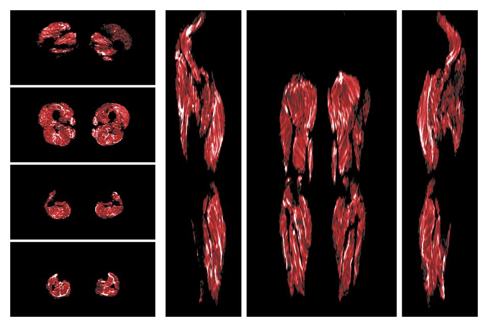 Muscle fiber tract density map based on whole leg DTI based fiber tractography.