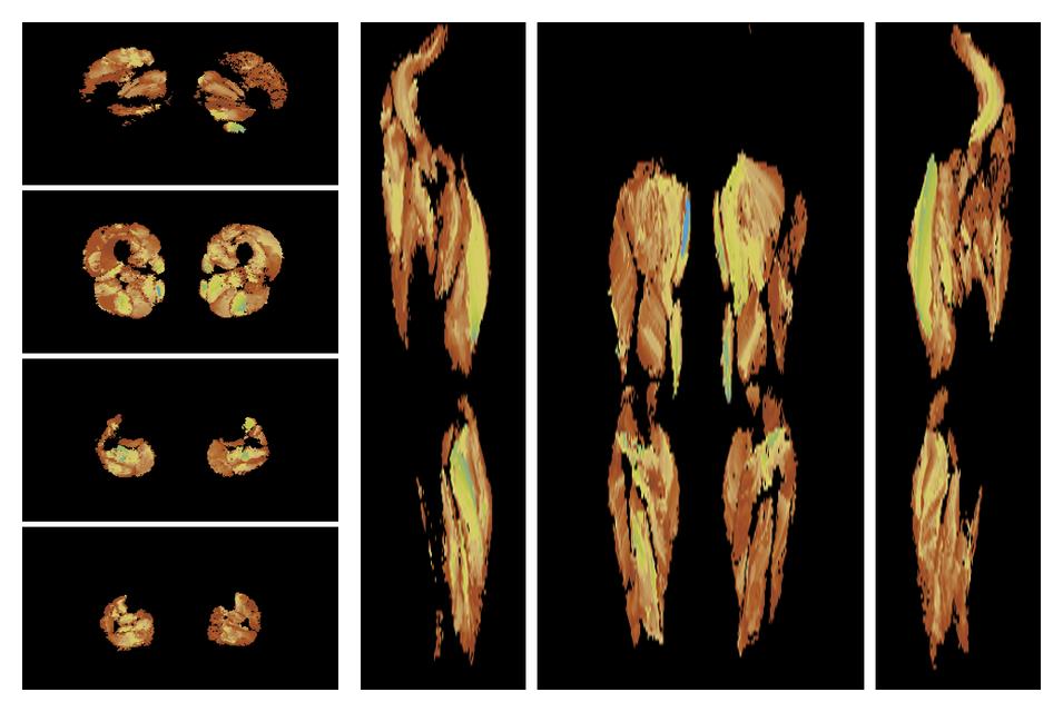 Muscle fiber tract length map based on whole leg DTI based fiber tractography.