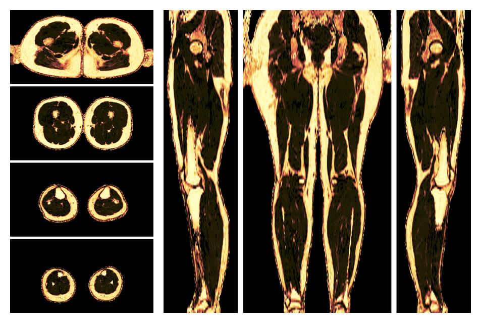 The fat fraction of the lower extremity obtained from the dixon reconstruction for muscle water fat quantification.