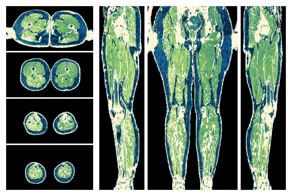 The R2 star relaxation time of the lower extremity obtained from the dixon reconstruction for muscle water fat quantification.