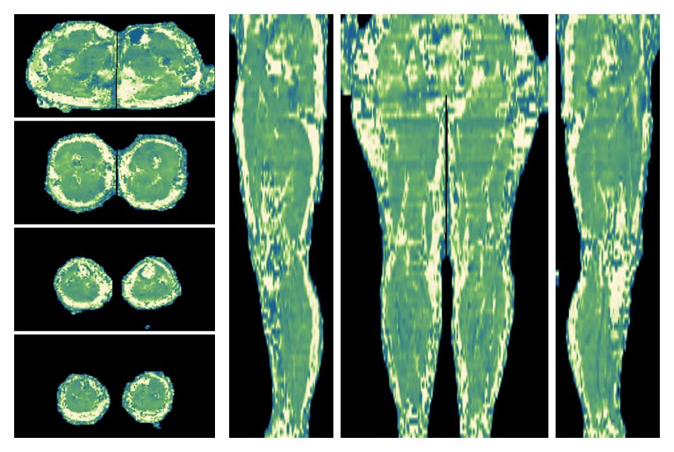 The water only T2 relaxation time of the lower extremity obtained from multi echo spin echo t2 mapping with EPG based reconstruction.