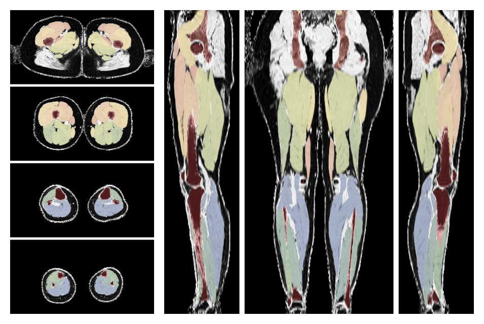 Overlay of automated muscle segmentation labels on dixon water image.