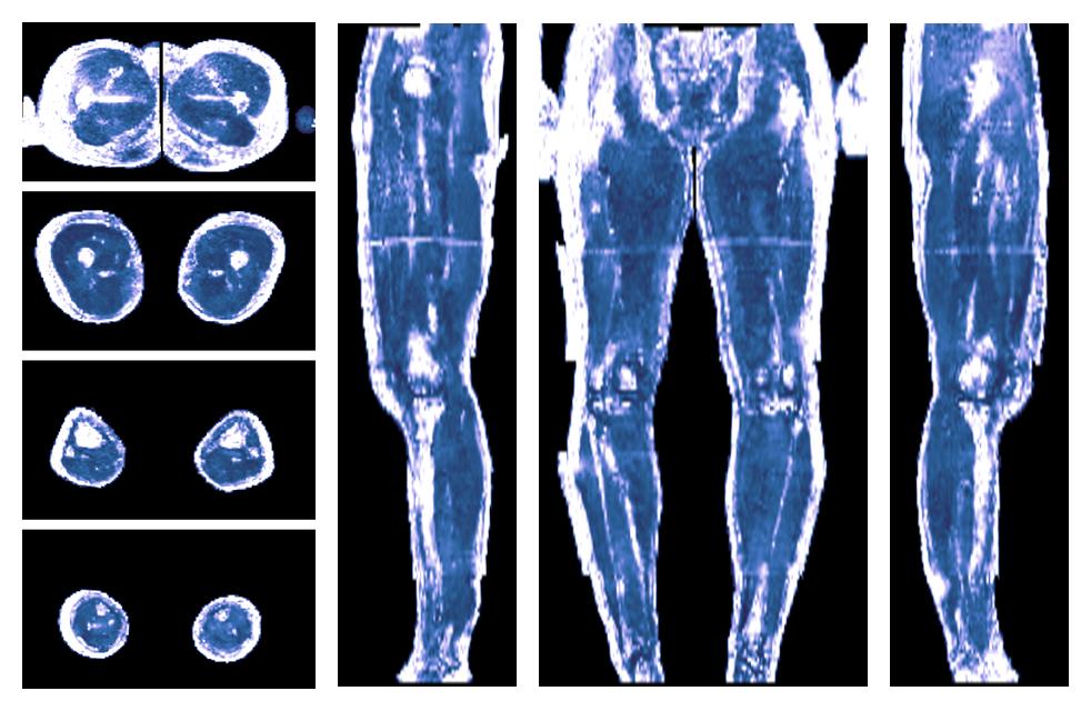 IVIM corrected whole leg muscle fractional anisotropy obtained from diffusion tensor imaging.