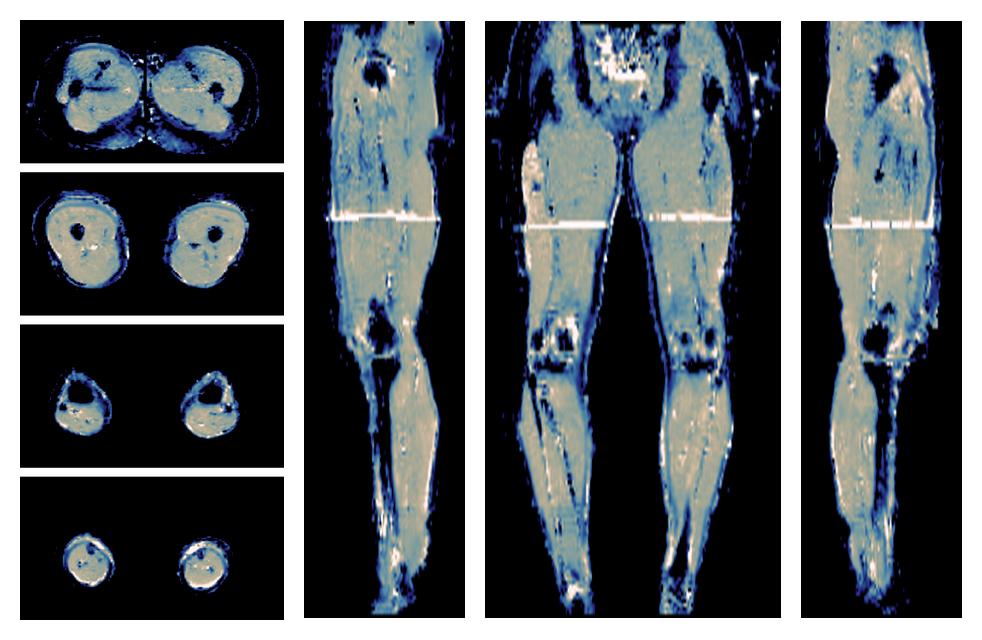 IVIM corrected whole leg muscle mean diffusivity obtained from diffusion tensor imaging.