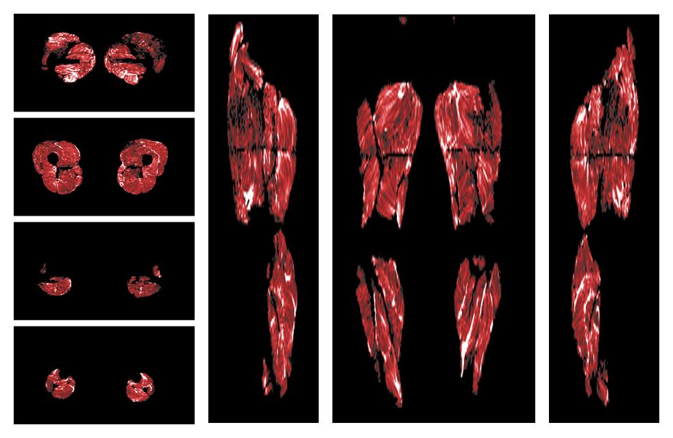 Muscle fiber tract density map based on whole leg DTI based fiber tractography.