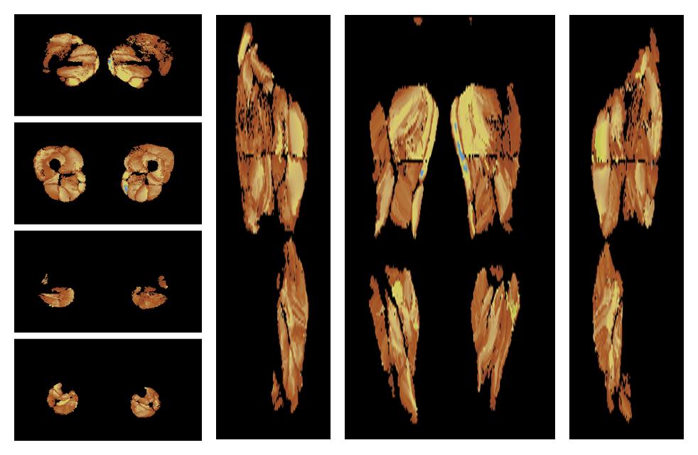 Muscle fiber tract length map based on whole leg DTI based fiber tractography.