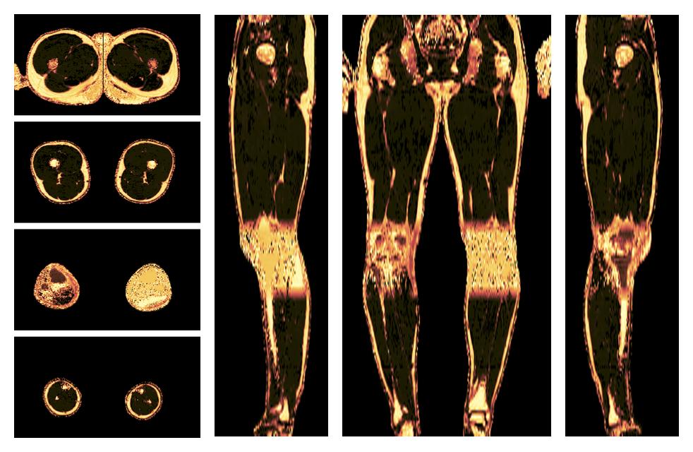 The fat fraction of the lower extremity obtained from the dixon reconstruction for muscle water fat quantification.