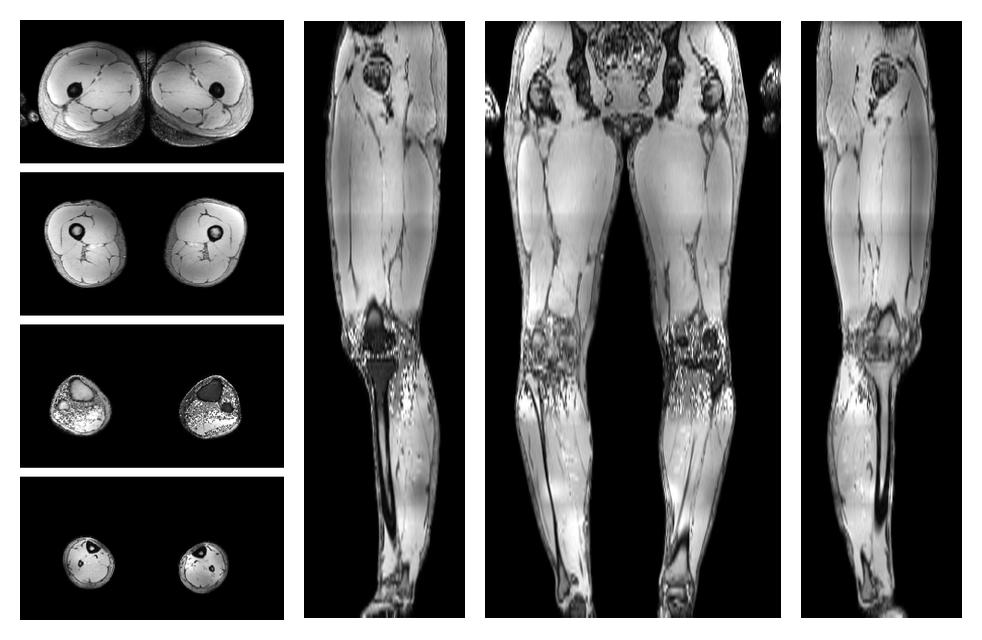 The out-phase image of the dixon reconstruction for water fat quantification.