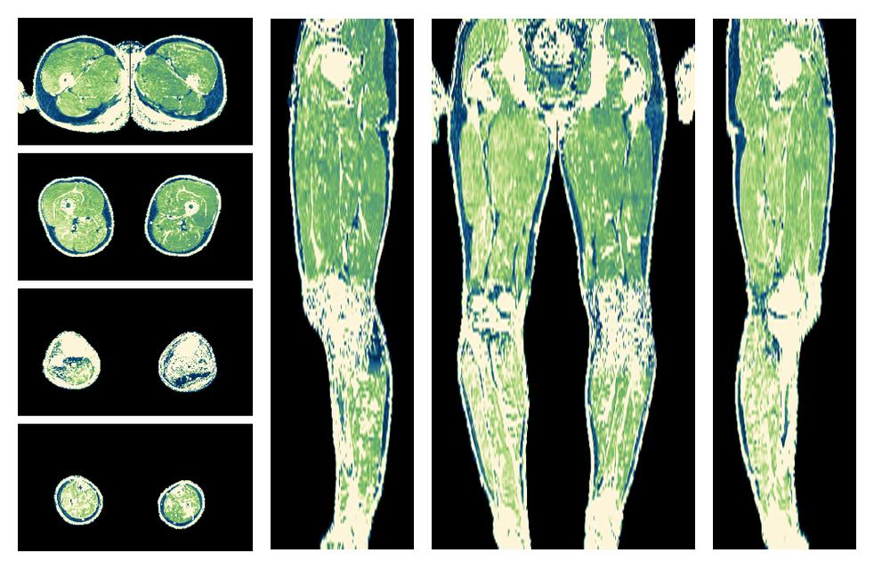 The R2 star relaxation time of the lower extremity obtained from the dixon reconstruction for muscle water fat quantification.