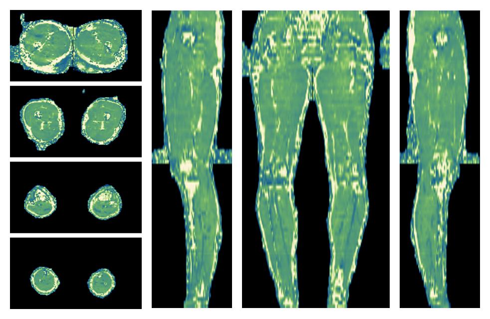 The water only T2 relaxation time of the lower extremity obtained from multi echo spin echo t2 mapping with EPG based reconstruction.