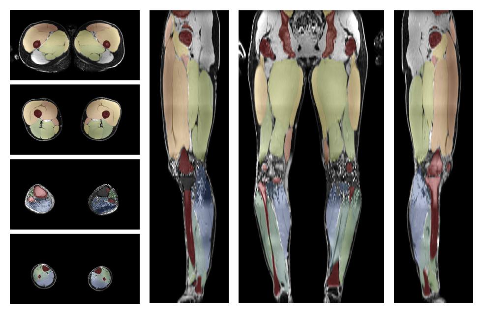 Overlay of automated muscle segmentation labels on dixon water image.