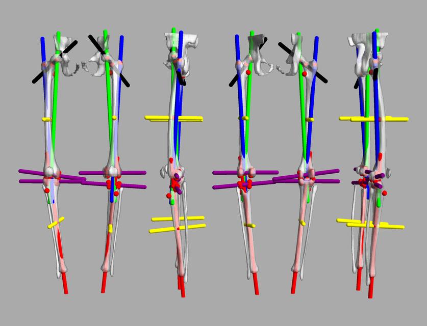 3D render of automated bone segmentation and force lines.